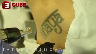 tattoo removal
